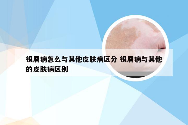银屑病怎么与其他皮肤病区分 银屑病与其他的皮肤病区别