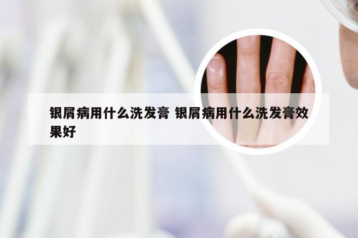 银屑病用什么洗发膏 银屑病用什么洗发膏效果好