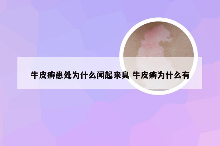 牛皮癣患处为什么闻起来臭 牛皮癣为什么有