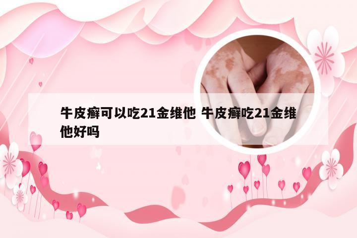 牛皮癣可以吃21金维他 牛皮癣吃21金维他好吗