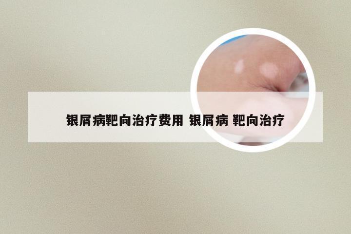 银屑病靶向治疗费用 银屑病 靶向治疗