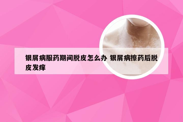 银屑病服药期间脱皮怎么办 银屑病擦药后脱皮发痒