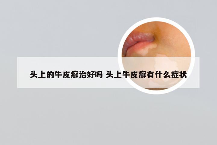 头上的牛皮癣治好吗 头上牛皮癣有什么症状