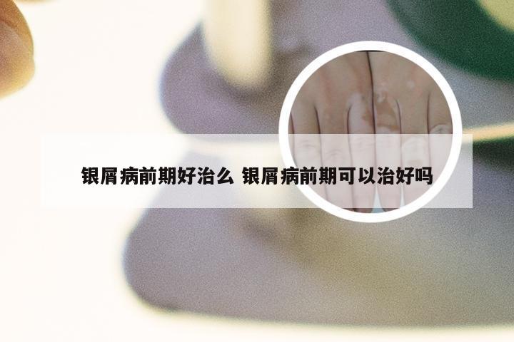 银屑病前期好治么 银屑病前期可以治好吗