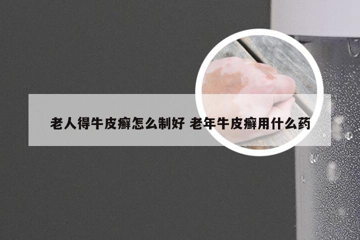 老人得牛皮癣怎么制好 老年牛皮癣用什么药