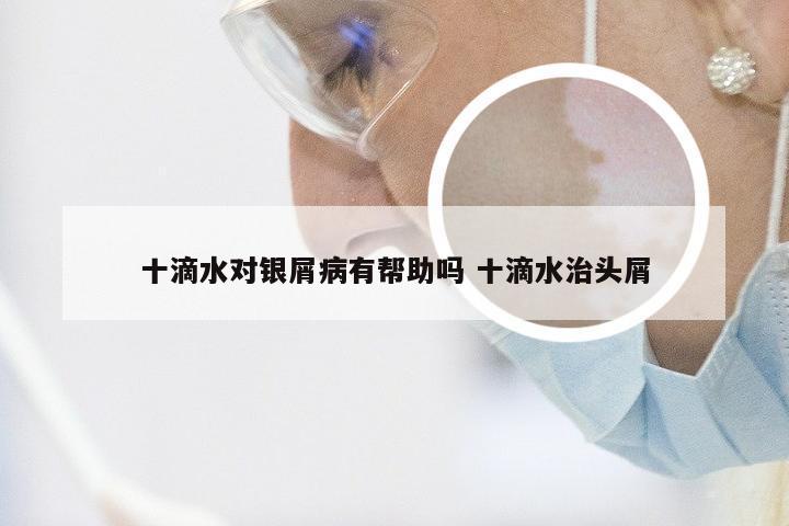十滴水对银屑病有帮助吗 十滴水治头屑