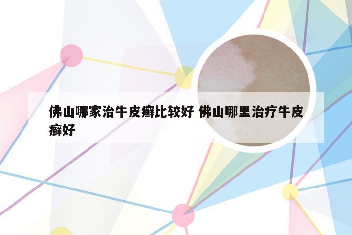 佛山哪家治牛皮癣比较好 佛山哪里治疗牛皮癣好