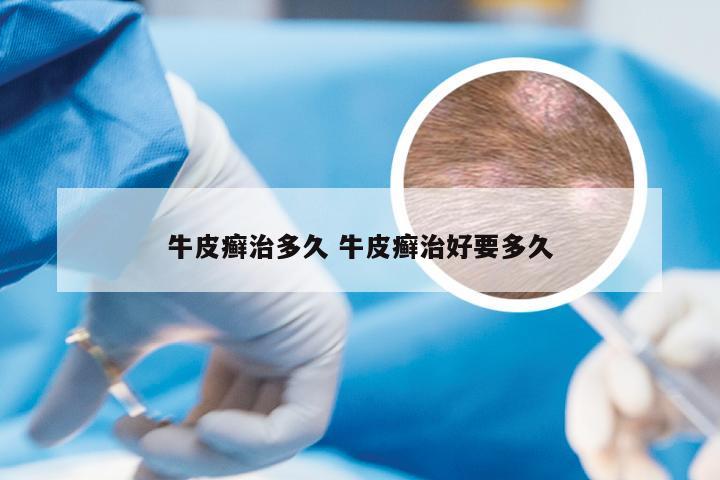 牛皮癣治多久 牛皮癣治好要多久