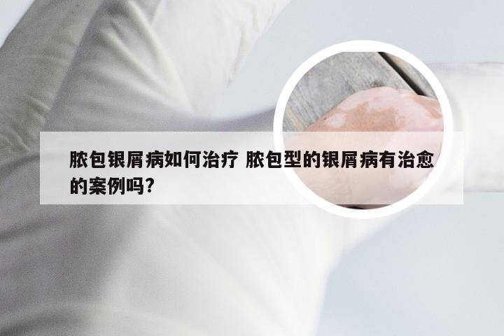 脓包银屑病如何治疗 脓包型的银屑病有治愈的案例吗?