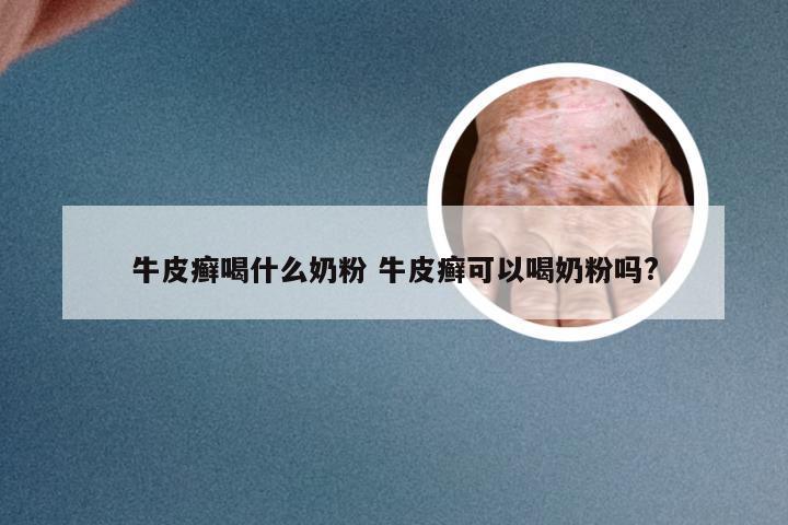 牛皮癣喝什么奶粉 牛皮癣可以喝奶粉吗?