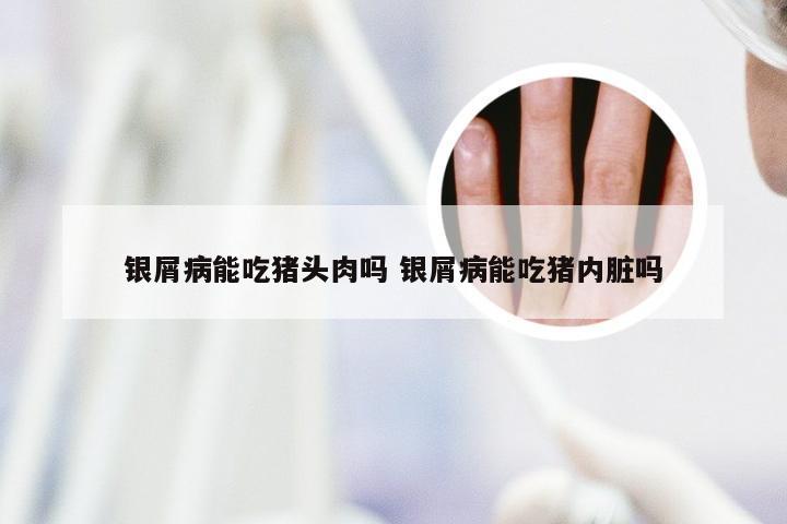 银屑病能吃猪头肉吗 银屑病能吃猪内脏吗