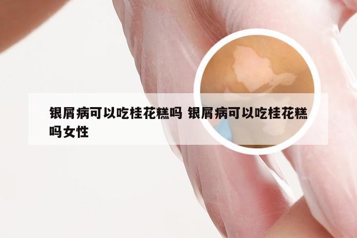 银屑病可以吃桂花糕吗 银屑病可以吃桂花糕吗女性