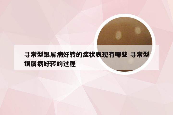 寻常型银屑病好转的症状表现有哪些 寻常型银屑病好转的过程