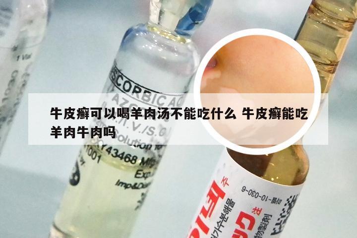 牛皮癣可以喝羊肉汤不能吃什么 牛皮癣能吃羊肉牛肉吗