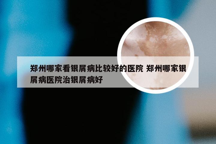 郑州哪家看银屑病比较好的医院 郑州哪家银屑病医院治银屑病好