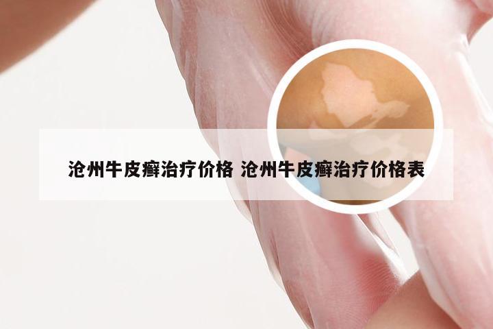 沧州牛皮癣治疗价格 沧州牛皮癣治疗价格表
