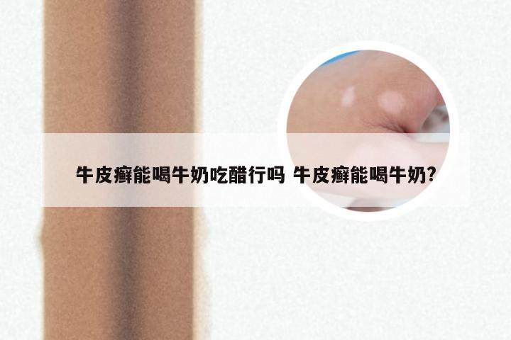 牛皮癣能喝牛奶吃醋行吗 牛皮癣能喝牛奶?