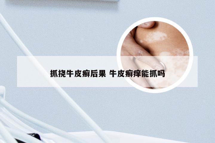 抓挠牛皮癣后果 牛皮癣痒能抓吗