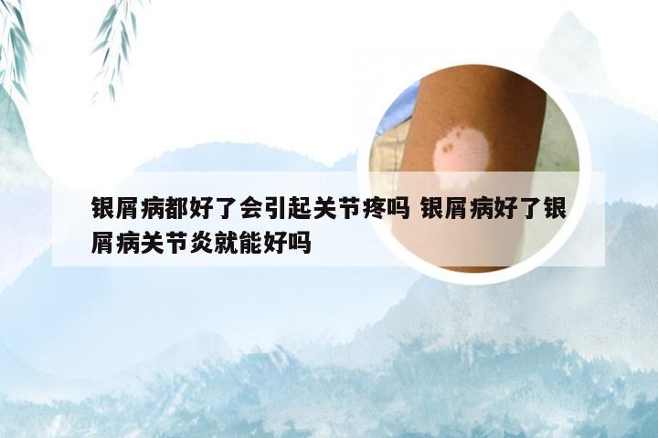 银屑病都好了会引起关节疼吗 银屑病好了银屑病关节炎就能好吗