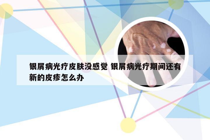 银屑病光疗皮肤没感觉 银屑病光疗期间还有新的皮疹怎么办