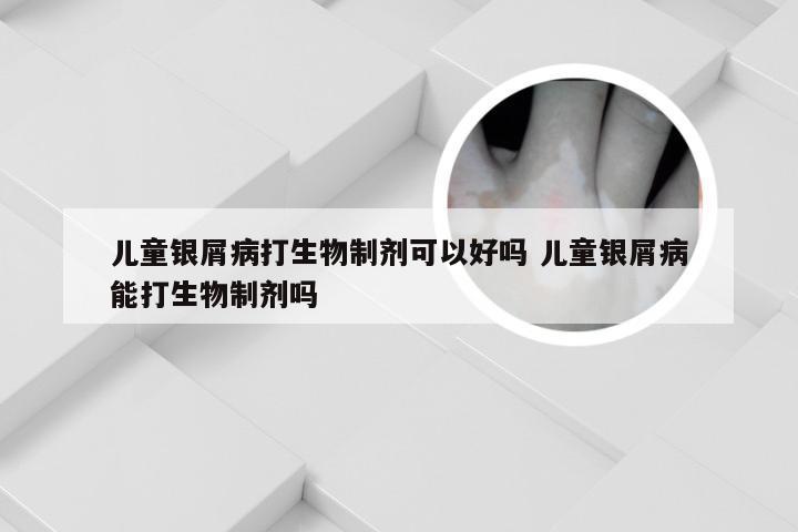 儿童银屑病打生物制剂可以好吗 儿童银屑病能打生物制剂吗