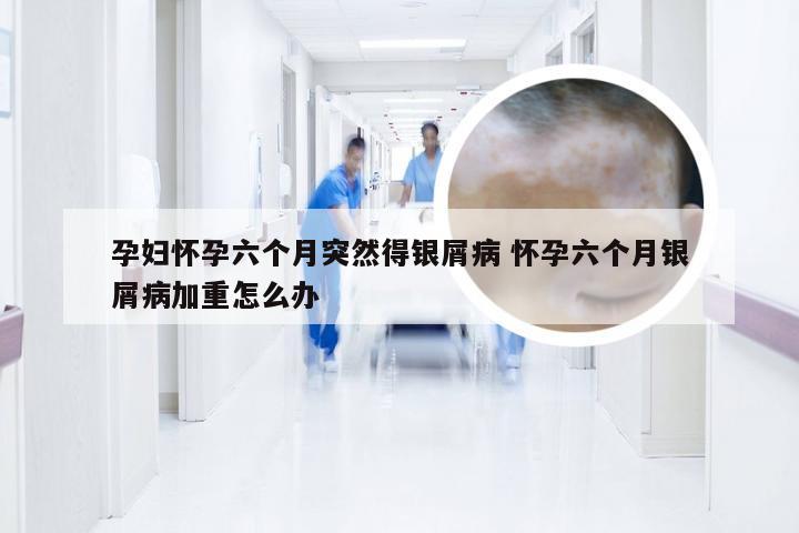 孕妇怀孕六个月突然得银屑病 怀孕六个月银屑病加重怎么办