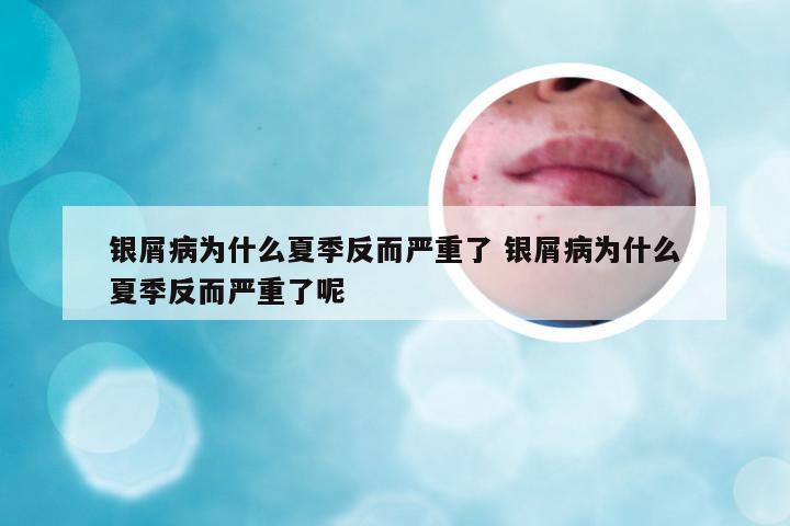 银屑病为什么夏季反而严重了 银屑病为什么夏季反而严重了呢