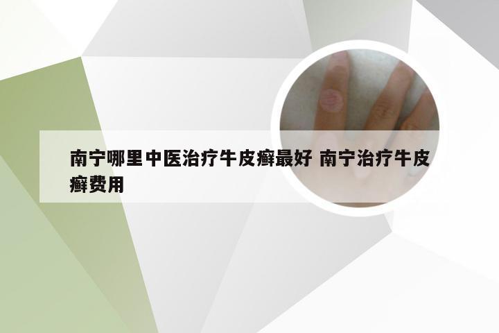 南宁哪里中医治疗牛皮癣最好 南宁治疗牛皮癣费用