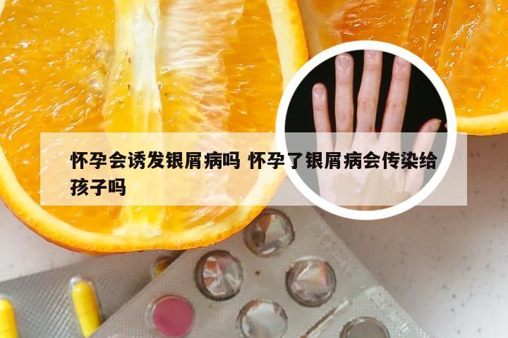 怀孕会诱发银屑病吗 怀孕了银屑病会传染给孩子吗