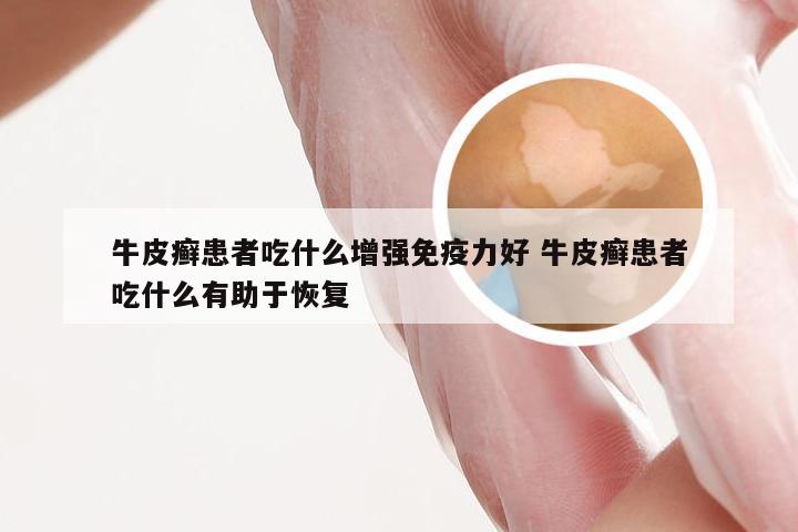 牛皮癣患者吃什么增强免疫力好 牛皮癣患者吃什么有助于恢复