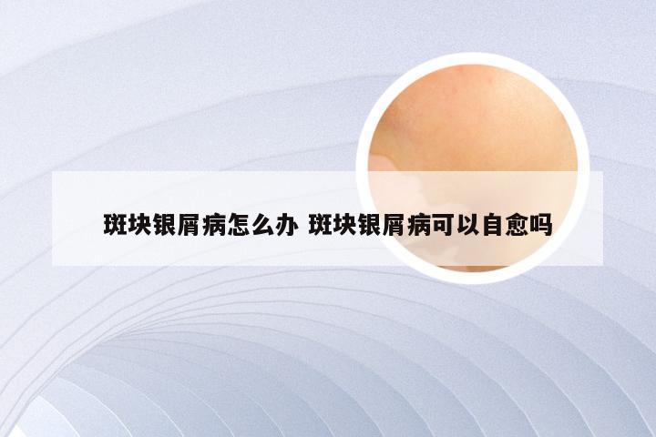 斑块银屑病怎么办 斑块银屑病可以自愈吗