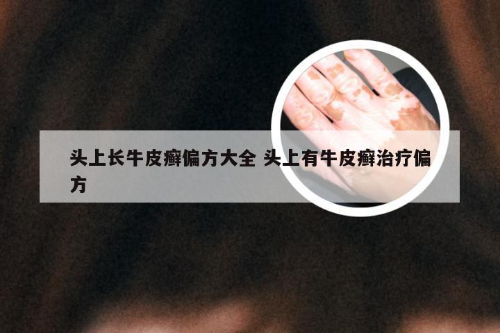 头上长牛皮癣偏方大全 头上有牛皮癣治疗偏方