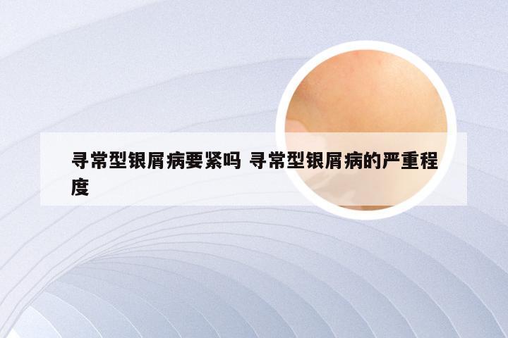 寻常型银屑病要紧吗 寻常型银屑病的严重程度