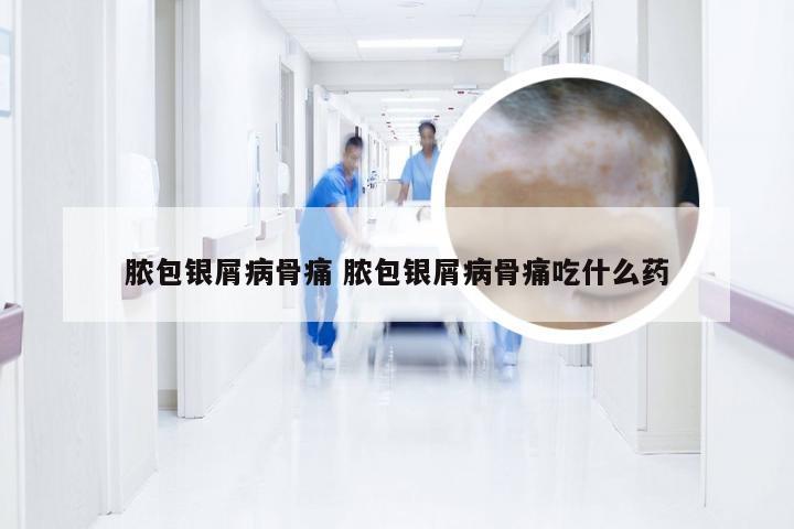脓包银屑病骨痛 脓包银屑病骨痛吃什么药