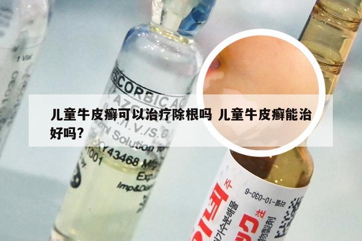 儿童牛皮癣可以治疗除根吗 儿童牛皮癣能治好吗?
