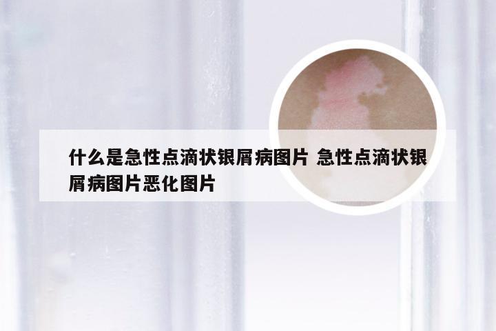 什么是急性点滴状银屑病图片 急性点滴状银屑病图片恶化图片
