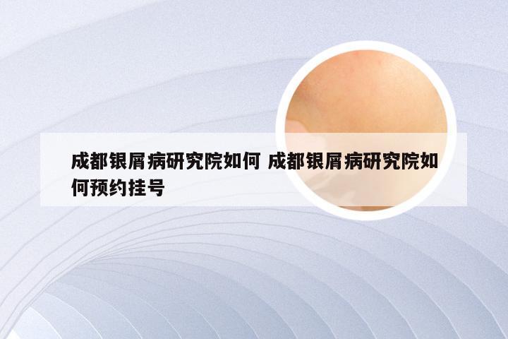 成都银屑病研究院如何 成都银屑病研究院如何预约挂号