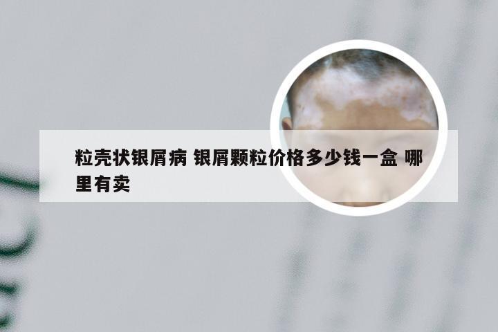粒壳状银屑病 银屑颗粒价格多少钱一盒 哪里有卖