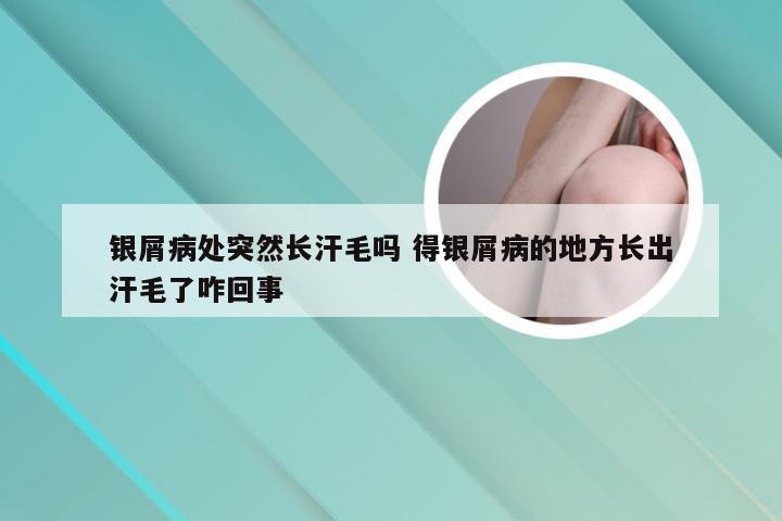 银屑病处突然长汗毛吗 得银屑病的地方长出汗毛了咋回事
