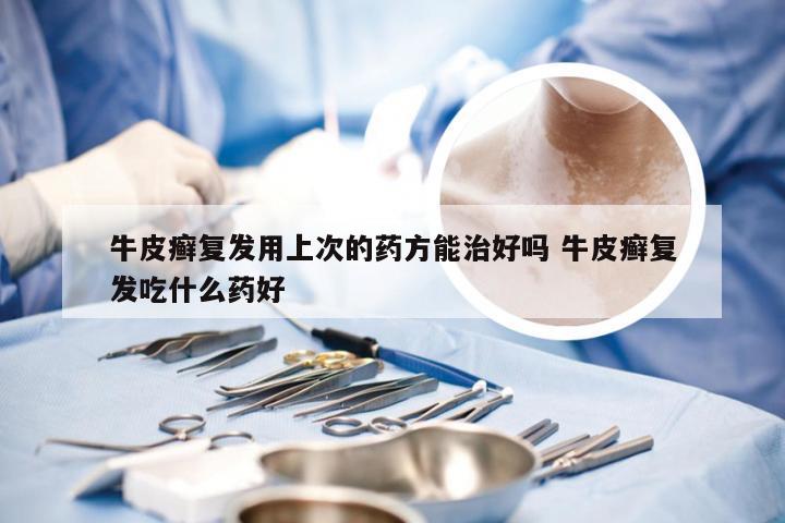 牛皮癣复发用上次的药方能治好吗 牛皮癣复发吃什么药好