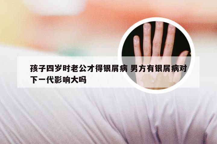 孩子四岁时老公才得银屑病 男方有银屑病对下一代影响大吗