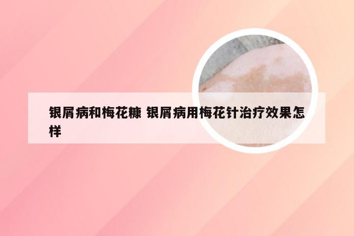 银屑病和梅花糠 银屑病用梅花针治疗效果怎样