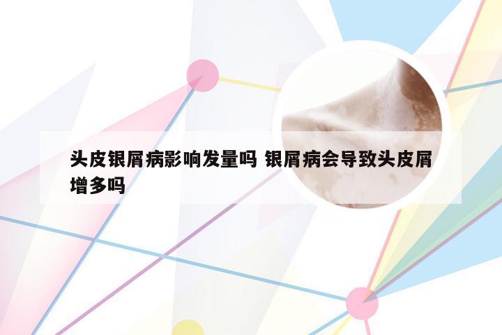 头皮银屑病影响发量吗 银屑病会导致头皮屑增多吗