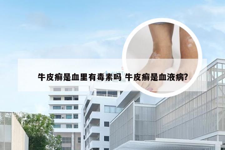 牛皮癣是血里有毒素吗 牛皮癣是血液病?
