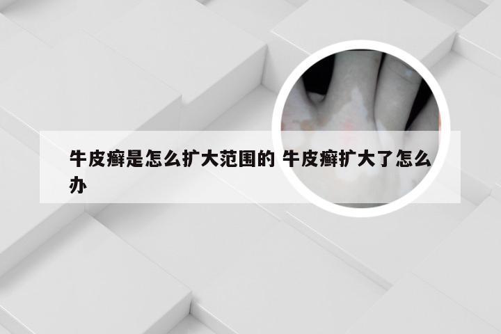 牛皮癣是怎么扩大范围的 牛皮癣扩大了怎么办