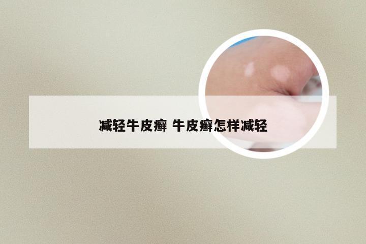 减轻牛皮癣 牛皮癣怎样减轻