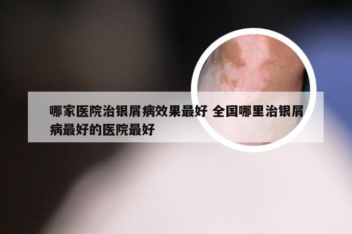 哪家医院治银屑病效果最好 全国哪里治银屑病最好的医院最好
