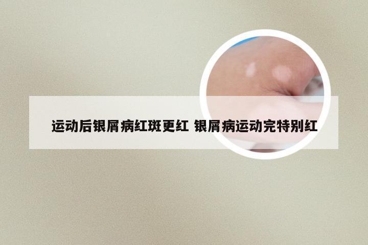 运动后银屑病红斑更红 银屑病运动完特别红