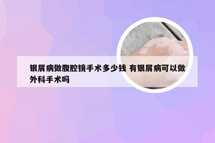 银屑病做腹腔镜手术多少钱 有银屑病可以做外科手术吗