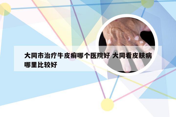 大同市治疗牛皮癣哪个医院好 大同看皮肤病哪里比较好